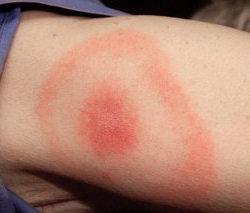 Farmers urged to take steps against tick bites