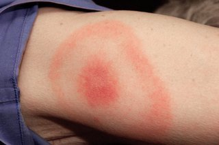 Farmers need to be aware of steps to protect against tick bites – DAFM